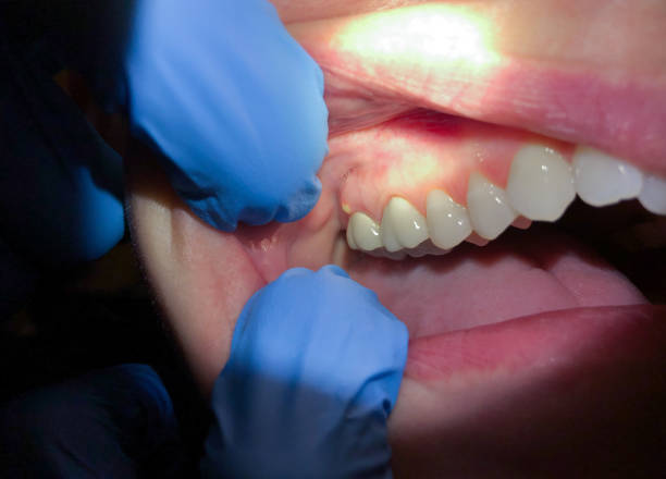 Best Emergency Tooth Extraction in Ste Genevieve, MO